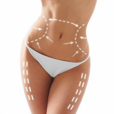 Liposuction