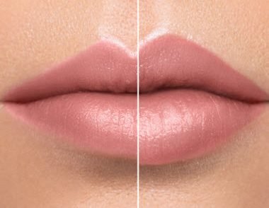 Lips fillers Beverly Hills