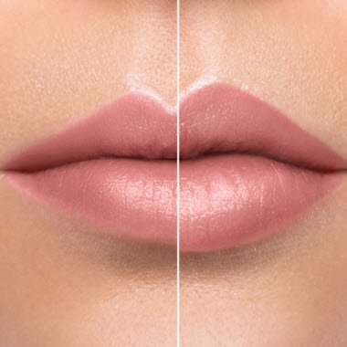 Fillers/Lips