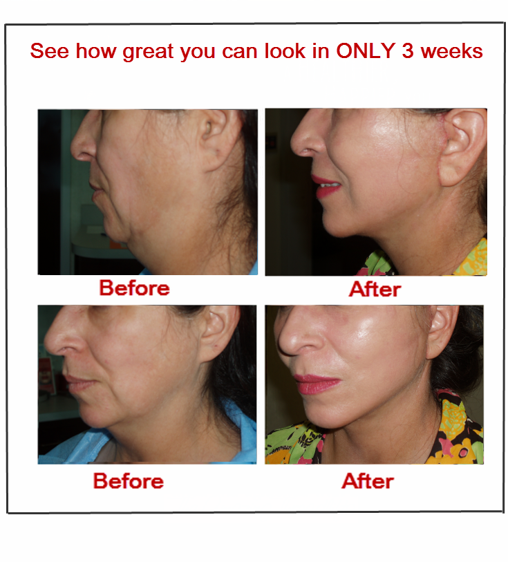 Mini facelift Cost Beverly Hills CA