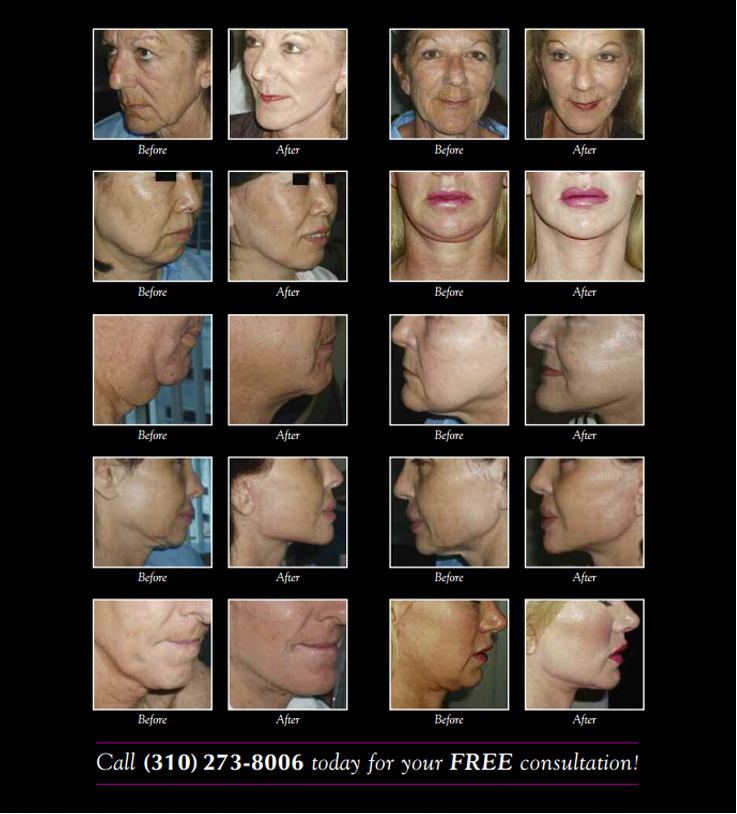 Best Mini facelift Beverly Hills doctor